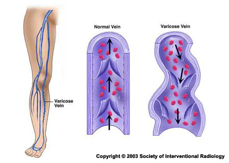 Varicose Veins Tritych