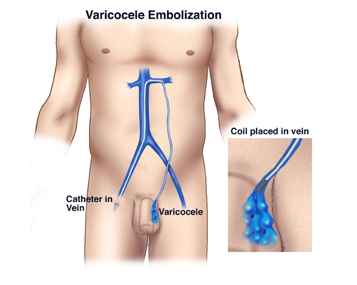 Varicocele Embolization with body