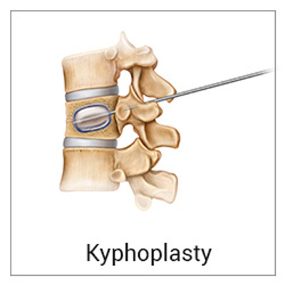 Image of kyphoplasty