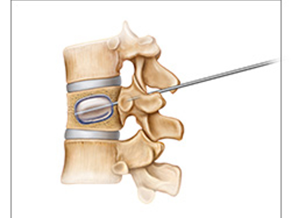 Image of kyphoplasty