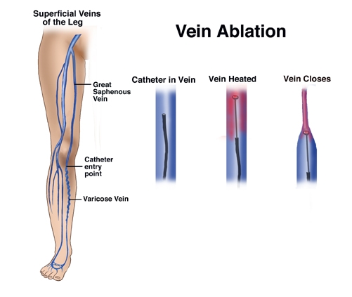 Vein Ablation Triptych