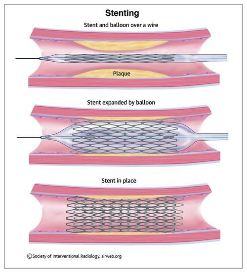 stenting-general-rev