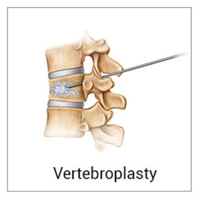 Vertebroplasty