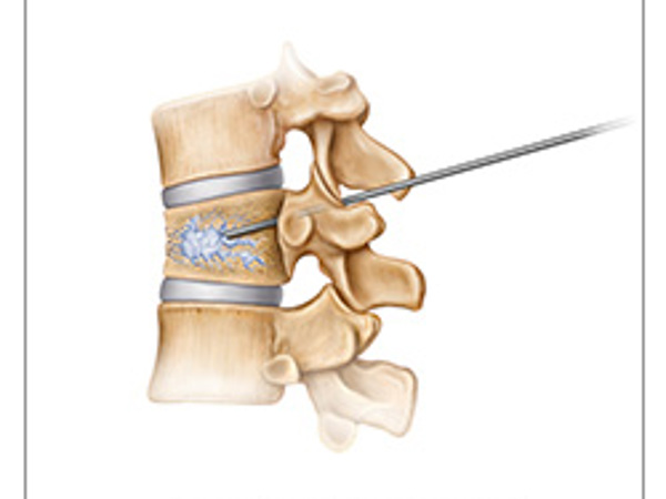 Vertebroplasty