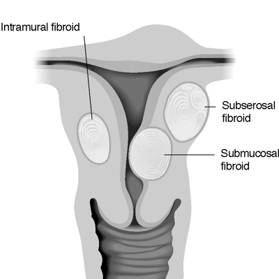 UFE-kinds of fibroids