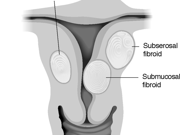 UFE-kinds of fibroids