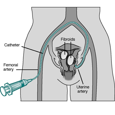 UFE Catheter