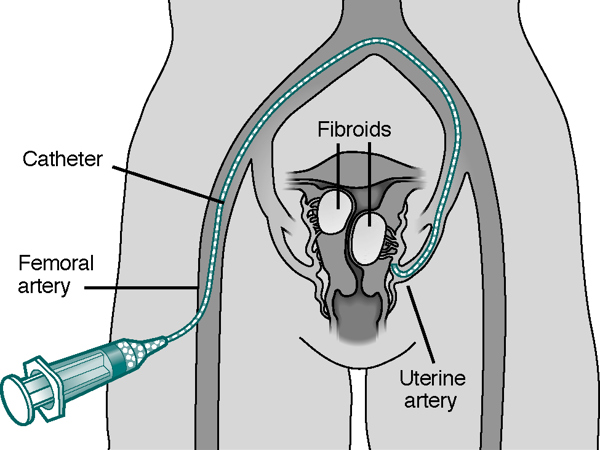 UFE Catheter